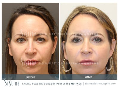 Blepharoplasty Before & After Gallery - Patient 371351 - Image 1