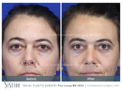 Fat Transfer Injections Before & After Gallery - Patient 274205 - Image 1