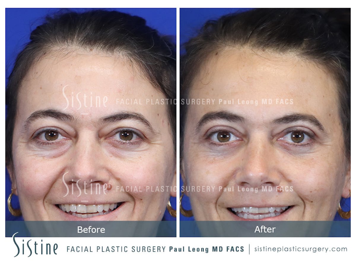 Fat Transfer Injections Before & After Gallery - Patient 274205 - Image 2