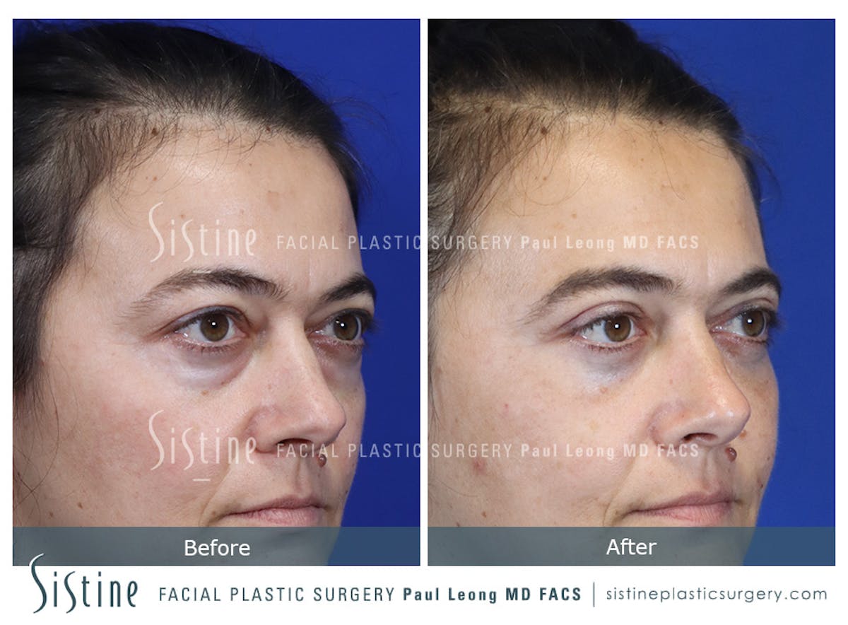 Fat Transfer Injections Before & After Gallery - Patient 274205 - Image 3