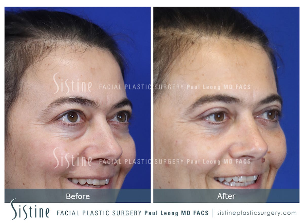 Fat Transfer Injections Before & After Gallery - Patient 274205 - Image 4