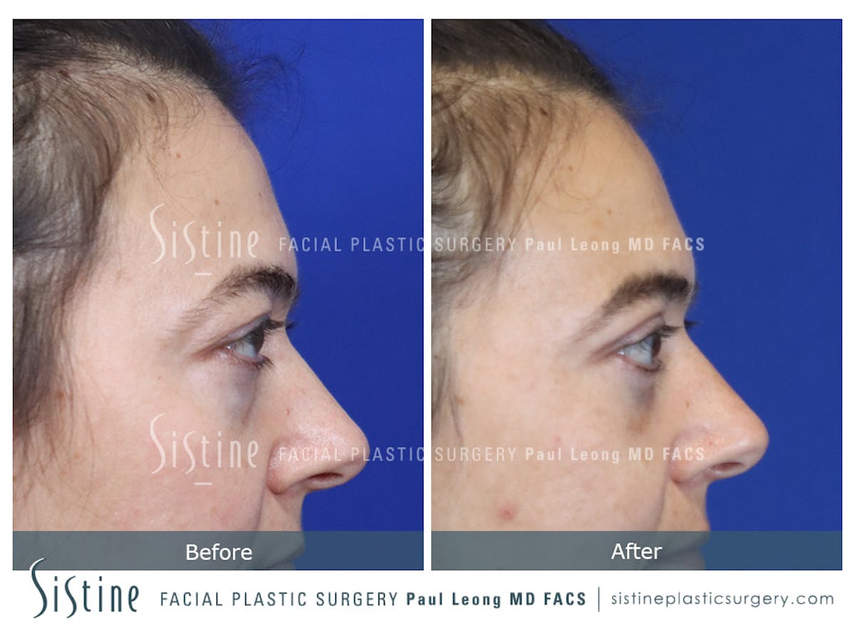 Fat Transfer Injections Before & After Gallery - Patient 274205 - Image 5