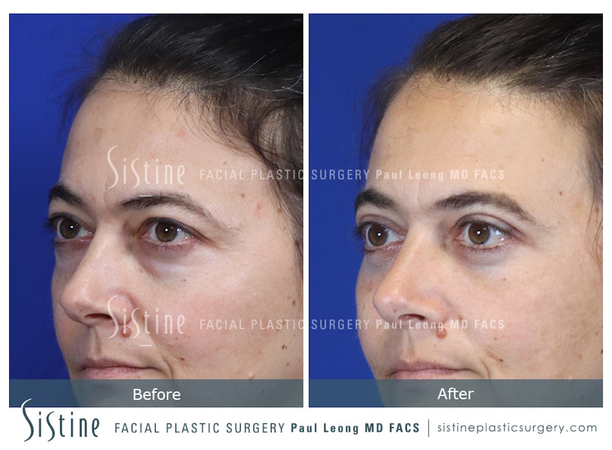 Fat Transfer Injections Before & After Gallery - Patient 274205 - Image 6