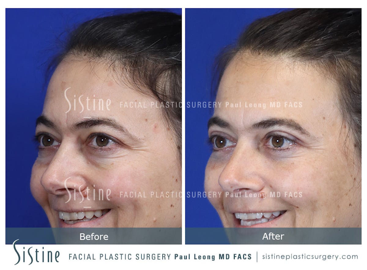 Fat Transfer Injections Before & After Gallery - Patient 274205 - Image 7