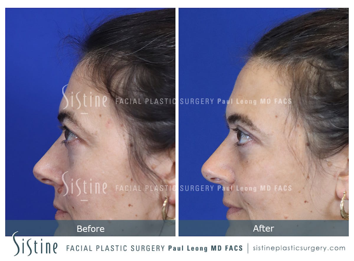 Fat Transfer Injections Before & After Gallery - Patient 274205 - Image 8