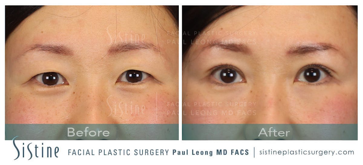 Asian Blepharoplasty Before & After Gallery - Patient 274668 - Image 1