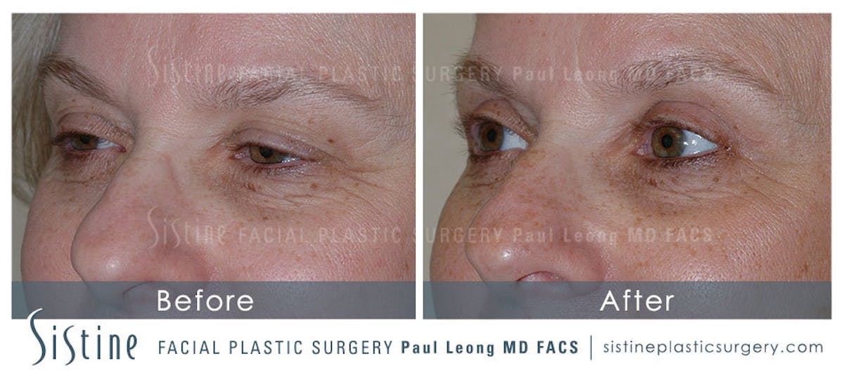 Blepharoplasty Before & After Gallery - Patient 151653 - Image 1