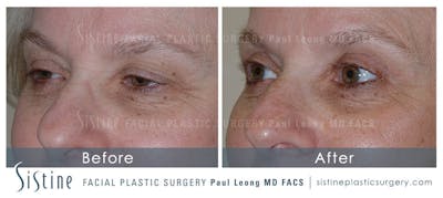 Eyes Before & After Gallery - Patient 351331 - Image 1