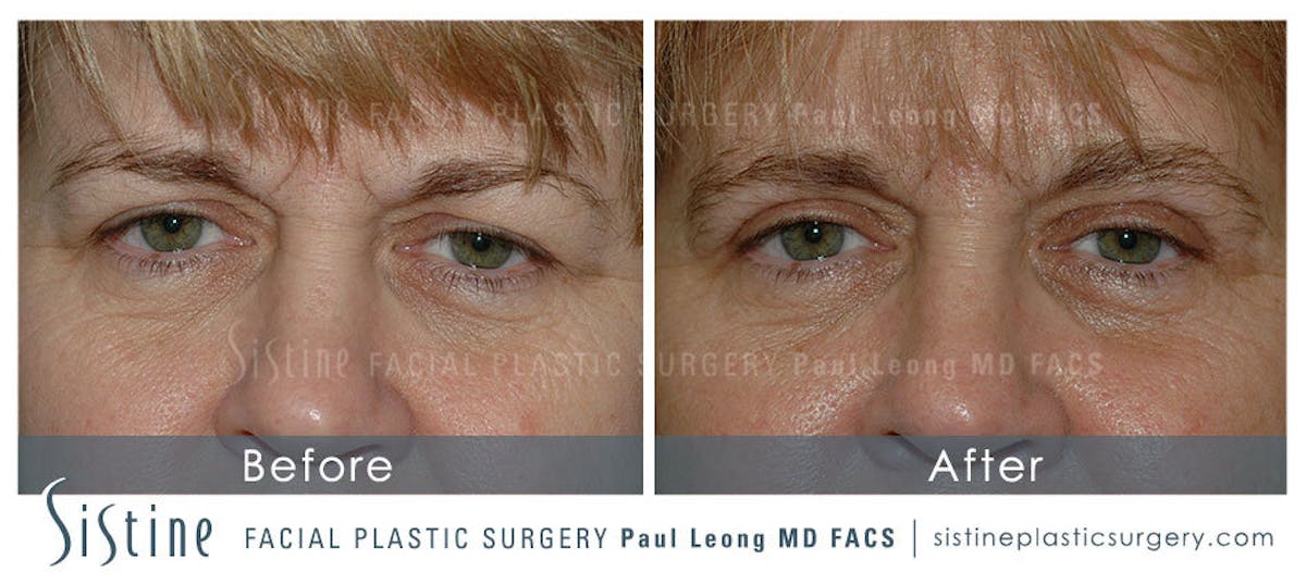 Blepharoplasty Before & After Gallery - Patient 150912 - Image 1
