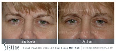 Eyes Before & After Gallery - Patient 183759 - Image 1