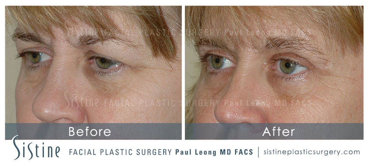 Blepharoplasty Before & After Gallery - Patient 150912 - Image 2