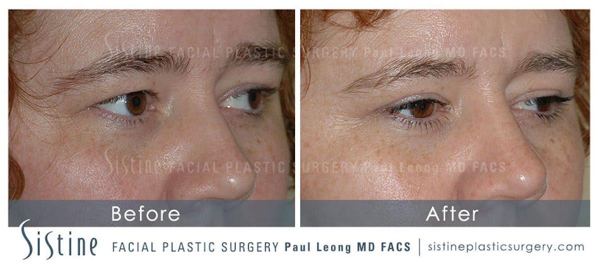 Blepharoplasty Before & After Gallery - Patient 402232 - Image 1