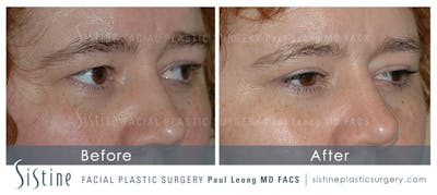 Eyes Before & After Gallery - Patient 399915 - Image 1