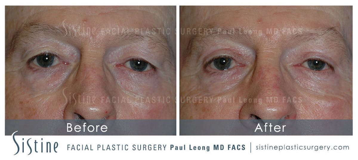 Blepharoplasty Before & After Gallery - Patient 414492 - Image 1