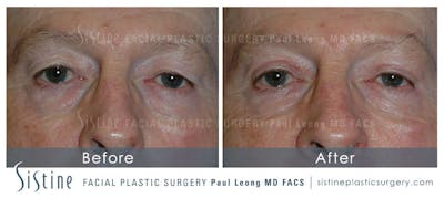 Blepharoplasty Before & After Gallery - Patient 414492 - Image 1
