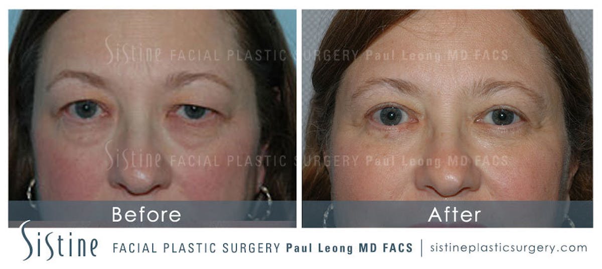 Blepharoplasty Before & After Gallery - Patient 133594 - Image 1
