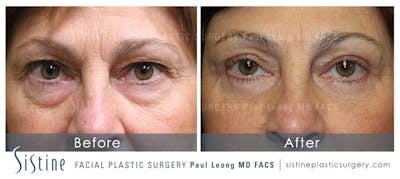 Eyes Before & After Gallery - Patient 311456 - Image 1
