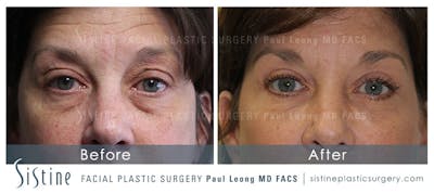 Eyes Before & After Gallery - Patient 399225 - Image 1