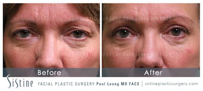 Eyes Before & After Gallery - Patient 406304 - Image 1