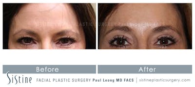 Eyes Before & After Gallery - Patient 135429 - Image 1