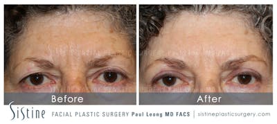 Eyes Before & After Gallery - Patient 140230 - Image 1