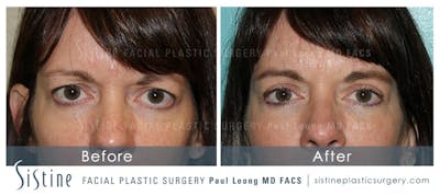 Eyes Before & After Gallery - Patient 370268 - Image 1