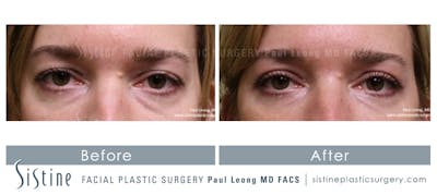 Eyes Before & After Gallery - Patient 339630 - Image 1