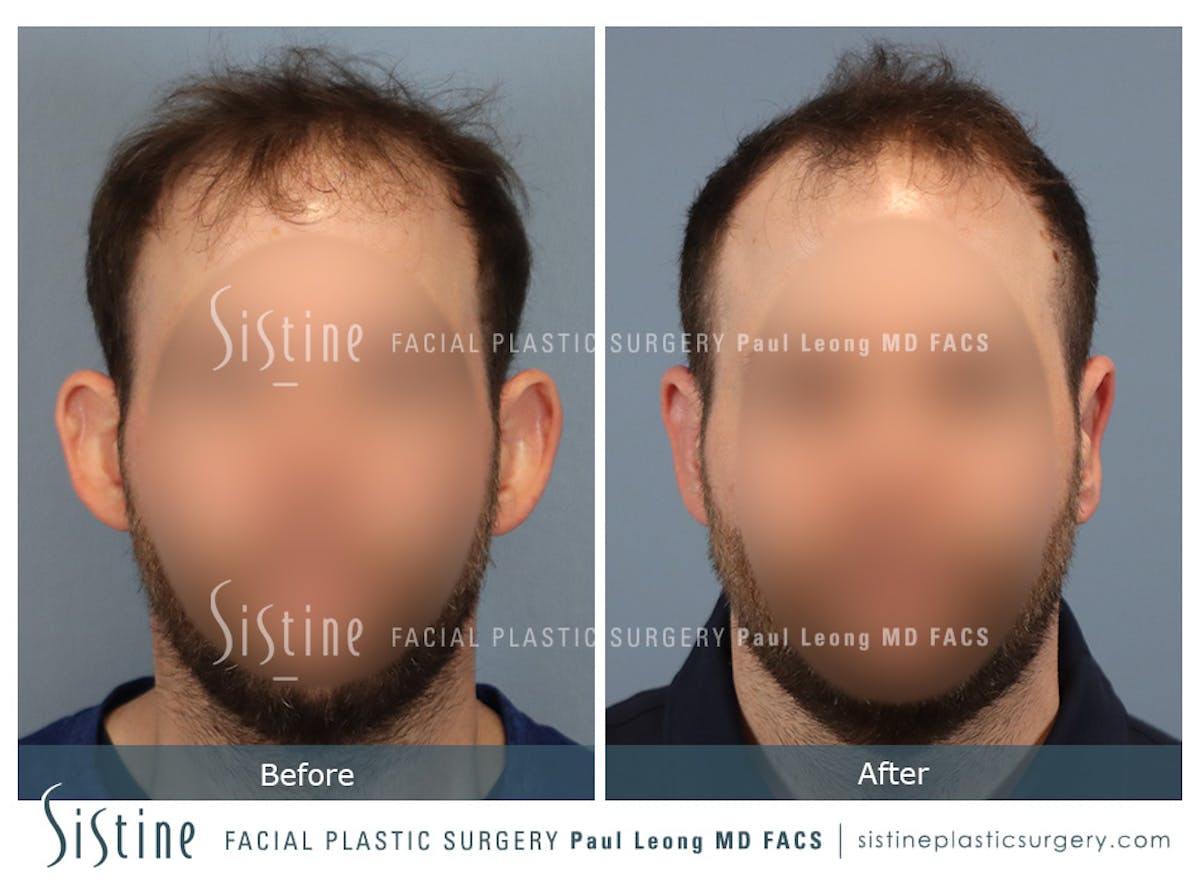 Otoplasty Before & After Gallery - Patient 277822 - Image 1