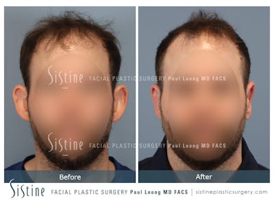 Otoplasty Before & After Gallery - Patient 277822 - Image 1