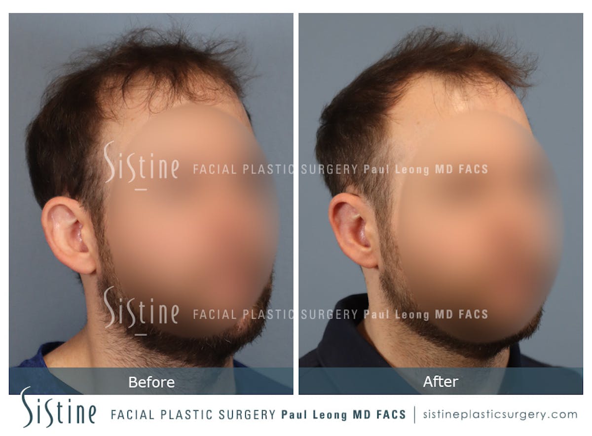 Otoplasty Before & After Gallery - Patient 277822 - Image 2