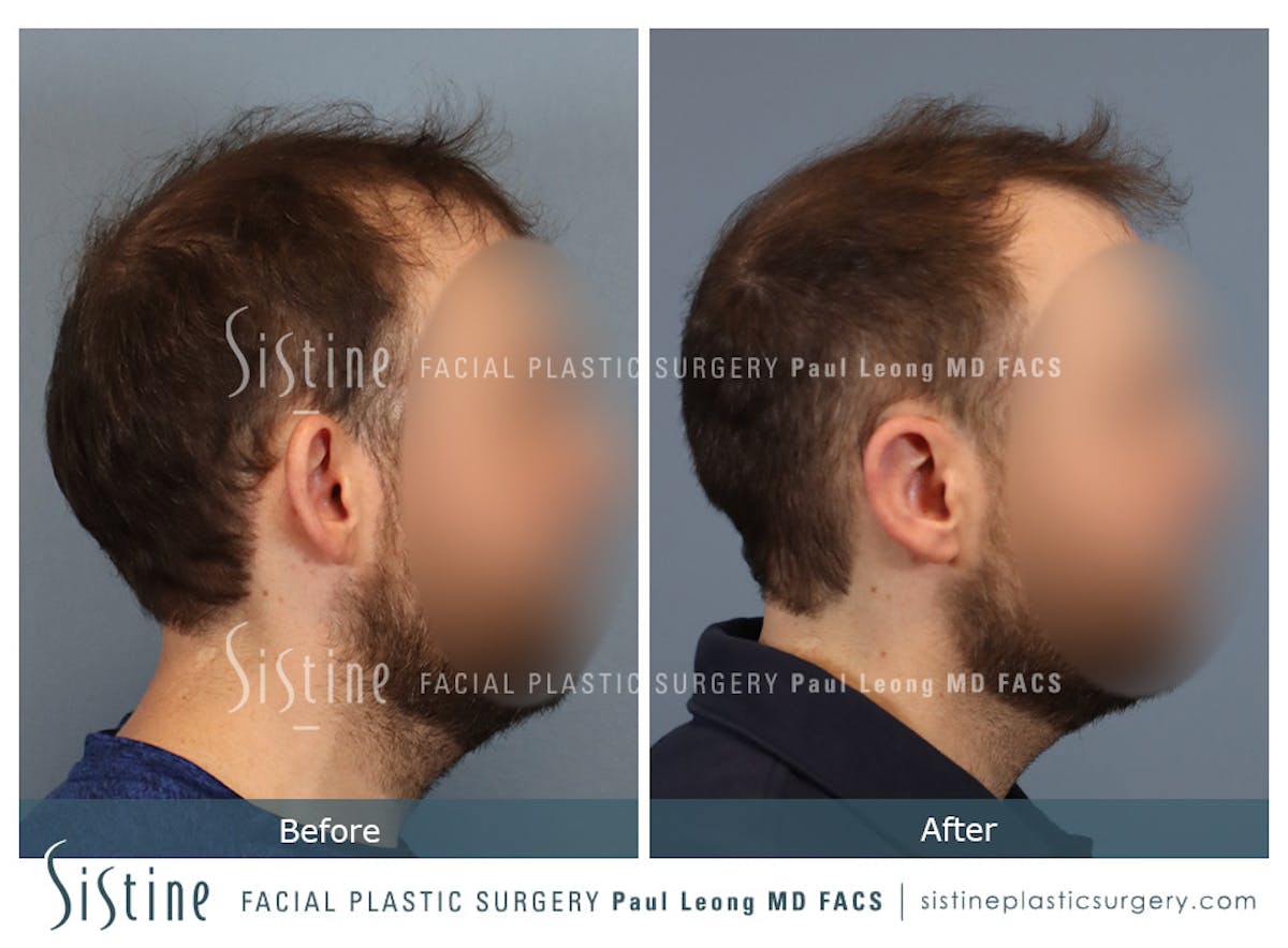 Otoplasty Before & After Gallery - Patient 277822 - Image 3
