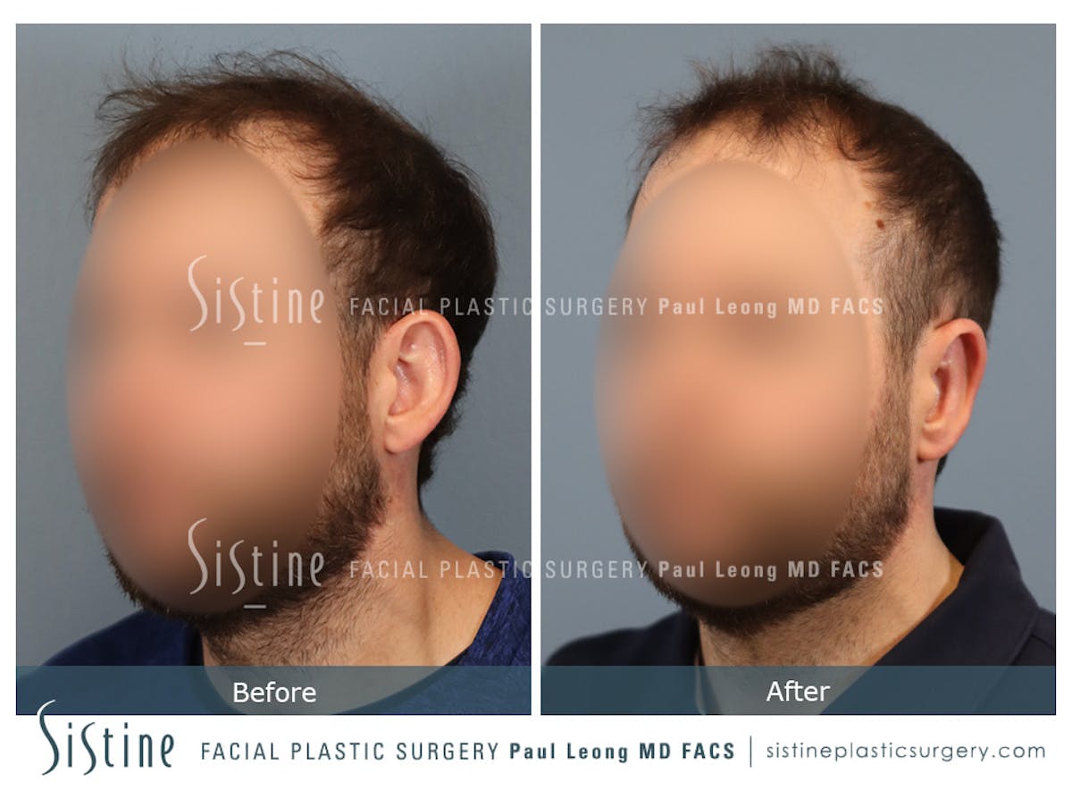 Otoplasty Before & After Gallery - Patient 277822 - Image 4
