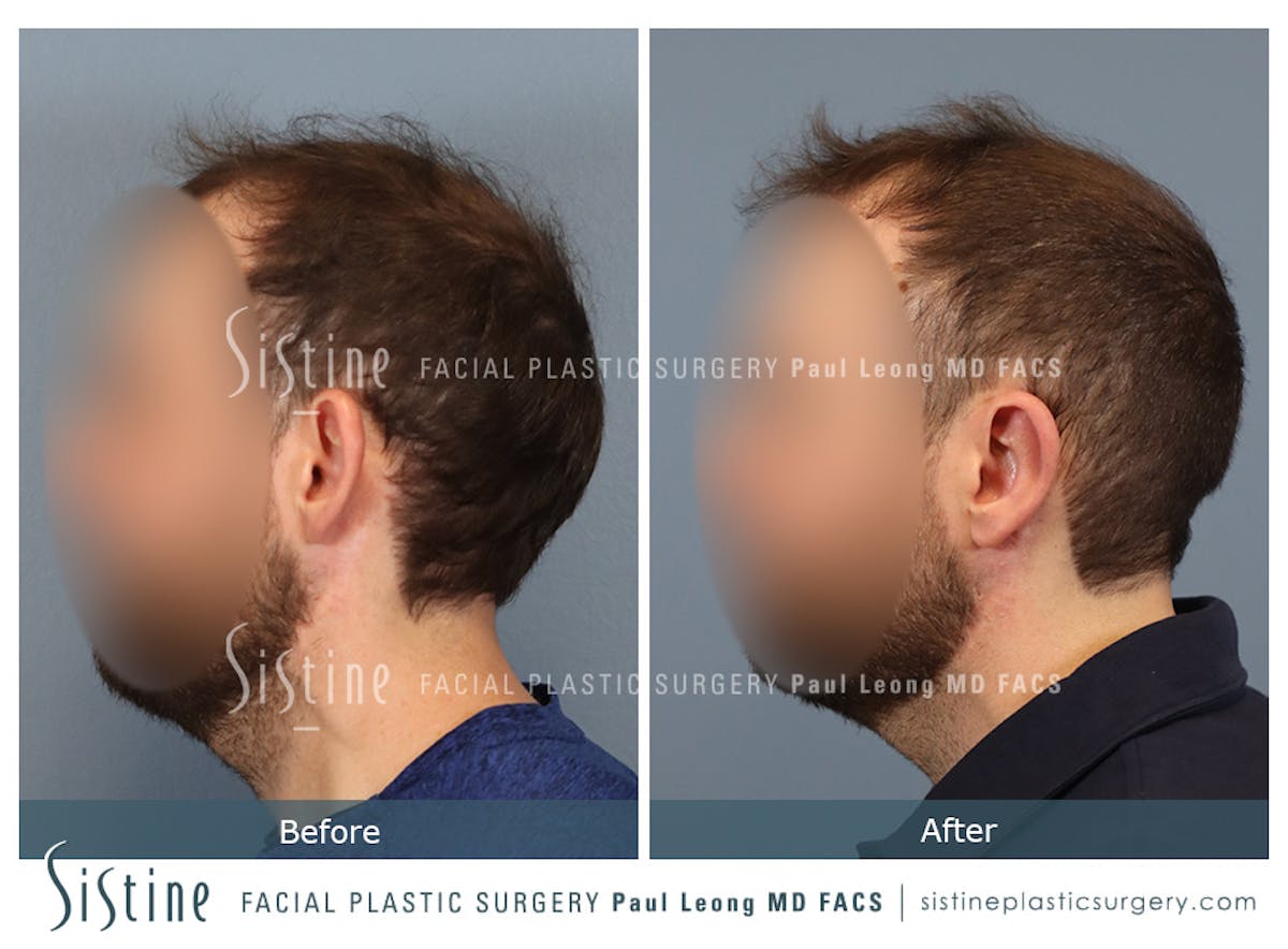 Otoplasty Before & After Gallery - Patient 277822 - Image 5