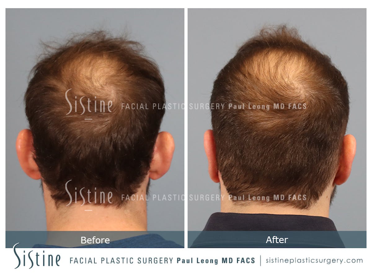 Otoplasty Before & After Gallery - Patient 277822 - Image 6
