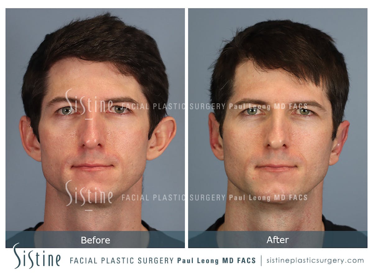 Otoplasty Before & After Gallery - Patient 323085 - Image 1