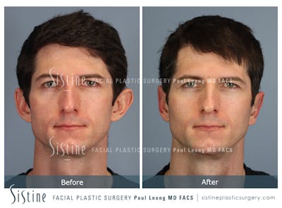 Otoplasty Before & After Gallery - Patient 323085 - Image 1