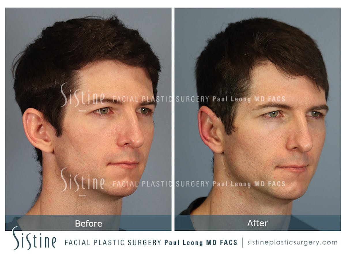 Otoplasty Before & After Gallery - Patient 323085 - Image 2