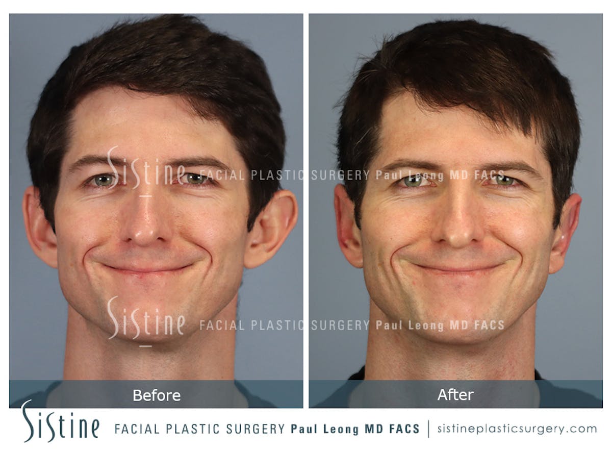 Otoplasty Before & After Gallery - Patient 323085 - Image 3