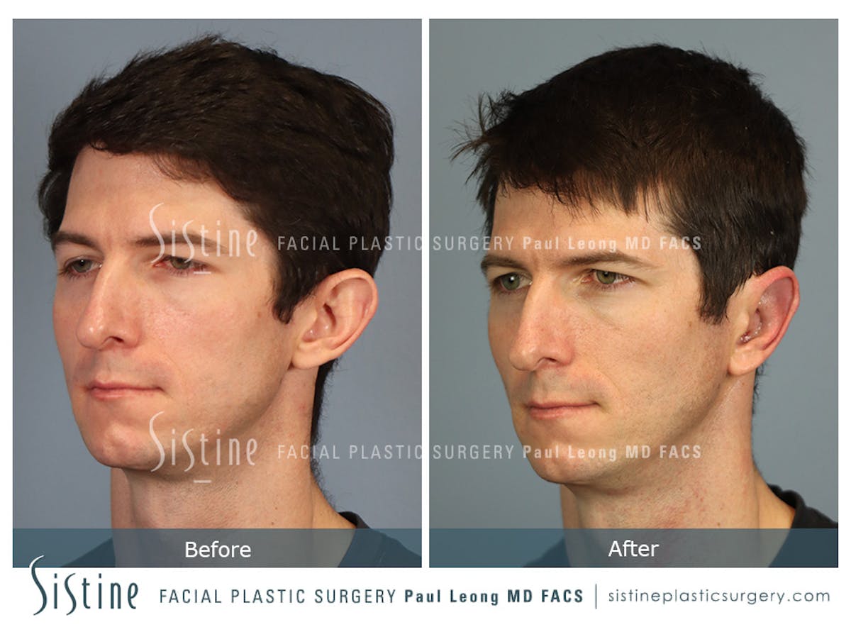 Otoplasty Before & After Gallery - Patient 323085 - Image 4