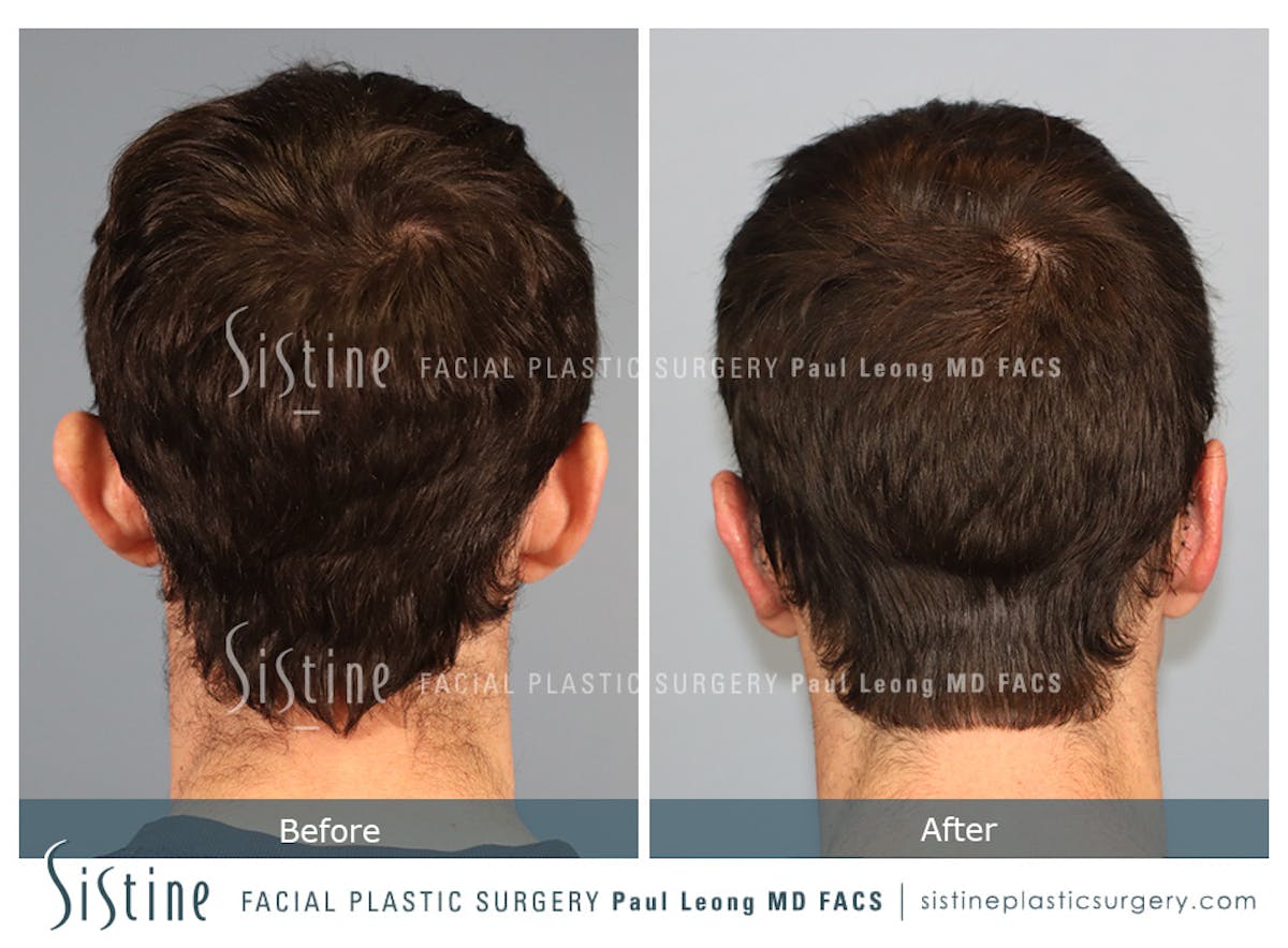 Otoplasty Before & After Gallery - Patient 323085 - Image 5
