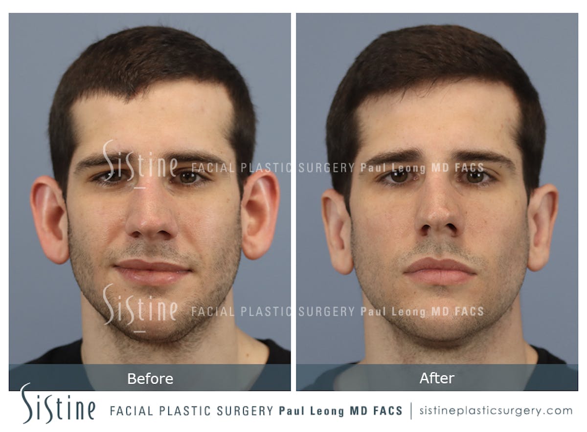 Otoplasty Before & After Gallery - Patient 369434 - Image 1