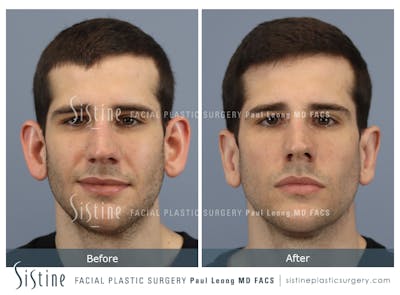 Otoplasty Before & After Gallery - Patient 369434 - Image 1