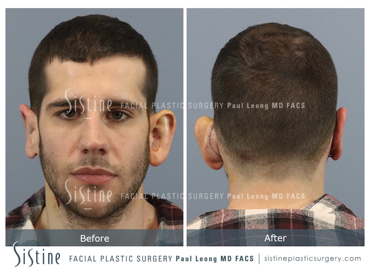 Otoplasty Before & After Gallery - Patient 369434 - Image 2
