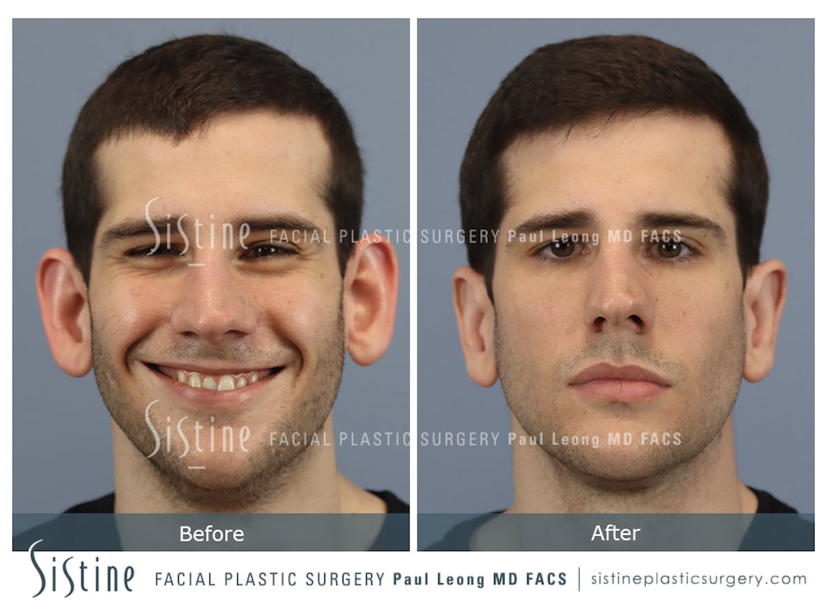 Otoplasty Before & After Gallery - Patient 369434 - Image 3