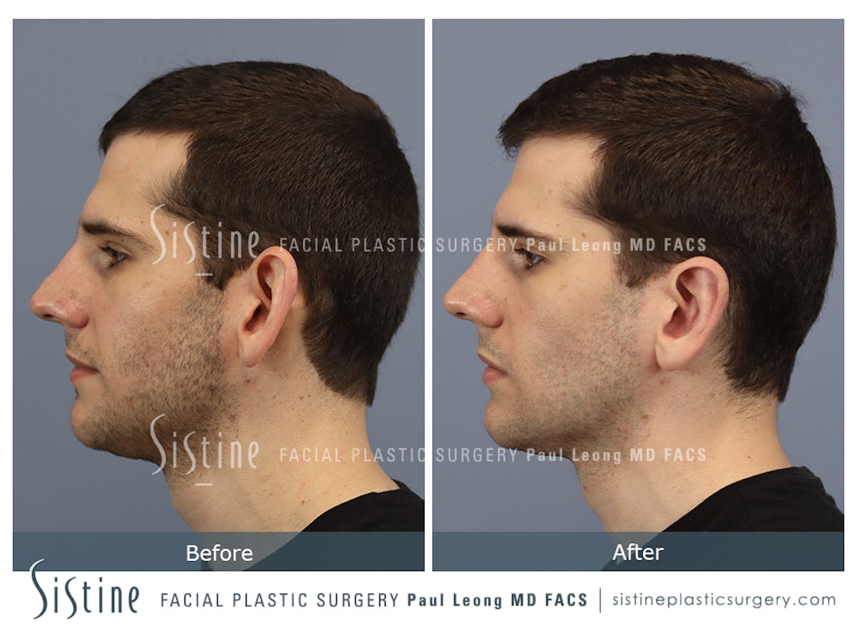 Otoplasty Before & After Gallery - Patient 369434 - Image 4