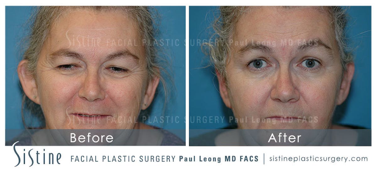 Ears Before & After Gallery - Patient 229081 - Image 1