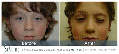 Otoplasty Before & After Gallery - Patient 138183 - Image 1