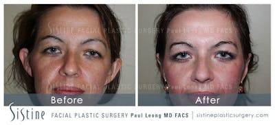 Otoplasty Before & After Gallery - Patient 265079 - Image 1