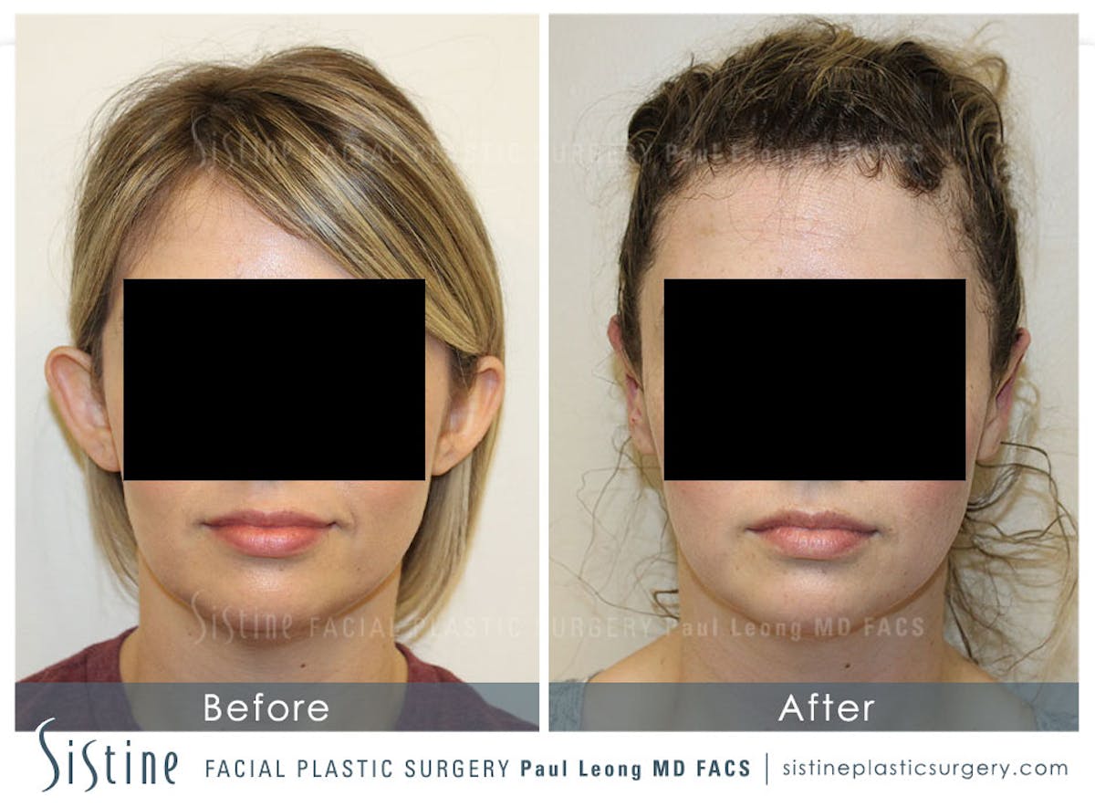 Ears Before & After Gallery - Patient 108651 - Image 1