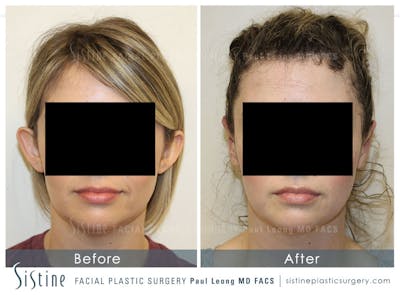 Otoplasty Before & After Gallery - Patient 704794 - Image 1
